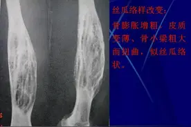 骨纤维异常增殖症影像诊断图片