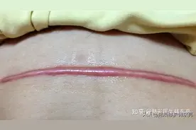 疤痕修复需要多少钱？看这一篇就够了！图片