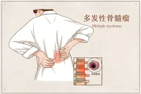 CAR T细胞疗法在耐药性多发性骨髓瘤患者的首次试验中被证明有效图片