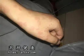 晚上身上痒一抓就红一片还凸起疙瘩，白天就好了是什么病？图片