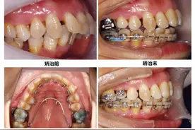 正畸并发症丨矫牙结束后，都会发生不同程度的牙根吸收？图片