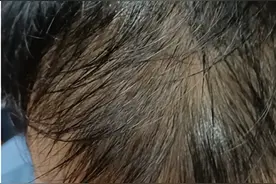 19岁男生脱发，医生找到根源！用药内服外涂，改善明显拯救秃头图片