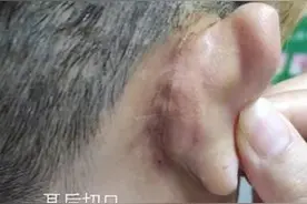 取不出来的耳屎，警惕中耳、外耳道胆脂瘤图片