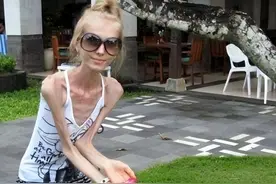 世界上最瘦的三个人，真的做到了瘦到只剩皮包骨图片