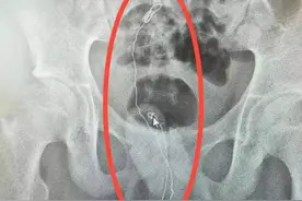 14岁男孩因为好奇，竟将铁丝塞入下体，足足20多厘米图片