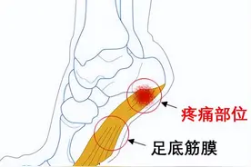 脚底总是疼，要小心这5种足部疾病“找麻烦”！图片