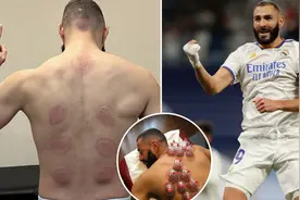 本泽马不老之谜：针灸+拔罐，欧美巨星也服图片