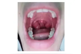 孩子扁桃体肿大，积食＋内热，一个方子，3天见效！图片