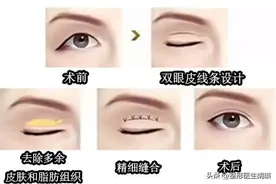 做双眼皮的都后悔了，后悔没在做之前看到，这篇文章都是干货图片