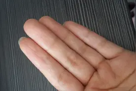 剥脱性角质松解症有多可怕？一年内多次复发，指纹也脱没了图片