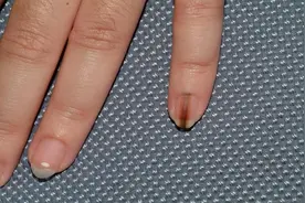 提醒：指甲若长成5种样子，可能是癌或疾病的信号，还请留心观察图片