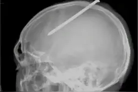 2010年，男子浑身无力说话困难，检查发现脑袋里有颗10厘米的钢钉图片