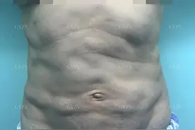 成都美女吸脂失败来找我做修复图片