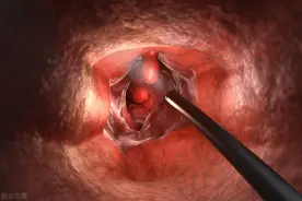 肠道里长了息肉，可能是这4个原因造成的，别不当回事图片