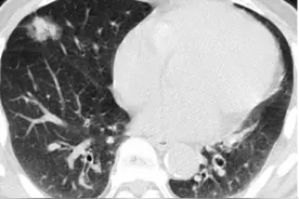 “肺结节”？请注意，肺结节的大小与结节的良恶性密切相关图片