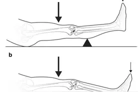 前交叉韧带损伤的相关解剖、分型、病因、症状、诊断和治疗图片