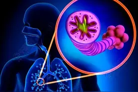 什么是“肺大疱”？体检时被查出来该怎么办？医生说出了真相图片