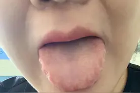 这几种舌苔，越补越上火你有吗图片
