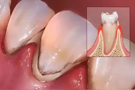 口腔医生：牙缝里的牙垢又臭又硬，教你1个小妙招，脏牙垢自动掉落！图片