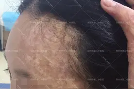 河南祛疤医院？色素疤痕怎么去除？图片