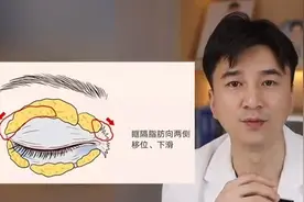 什么是眶隔脂肪释放？图片