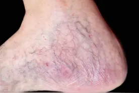 医生：腿上有“红血丝”的人可能是身体发出的危险信号，要注意了图片