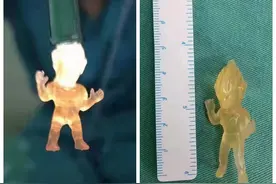 6岁男娃逞英雄，毅然吞下“奥特曼”图片