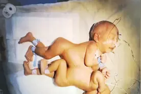 14年前湖南省首例接受分离手术的连体女婴，如今活成这样！图片