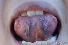 舌头底下有两条“大青筋”，代表身体出问题了？又该如何调理？图片