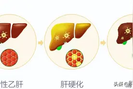 乙肝到肝硬化是必然还是偶然？图片