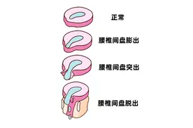 腰椎间盘膨出、突出、脱出，哪种情况就要手术了？图片