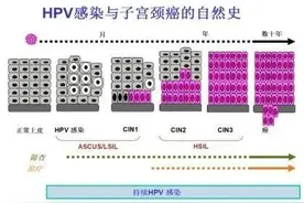 为什么HPV没有特效药？感染了HPV后应该如何治疗？图片