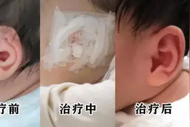 耳廓畸形影响大，尽早治疗很关键！图片