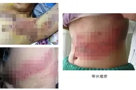 带状疱疹：让人疼痛难忍，还可能是癌症预警！这几类人要特别警惕图片