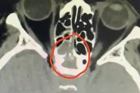 头疼得痛不欲生！长沙69岁奶奶感到头要“爆炸”，竟是鼻腔“长霉”引起图片