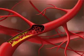 你的血管或许在悄悄长斑！这样做，“斑块”可能缩小→图片