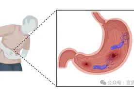 幽门螺杆菌阳性别慌！图片