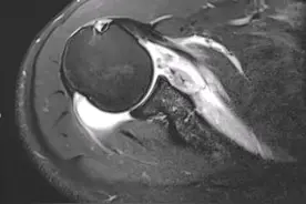 右肩反复脱位11年严重影响工作 关节外科专家高玉镭主任“精准修复”解除危机图片