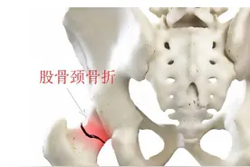 长沙市第一医院：高龄老人骨折 “破局”，术后首日即下床行走图片