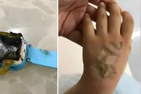 手臂烧伤、近视“狂飙”……儿童智能手表真的安全吗？图片