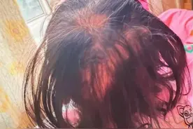 湖南3岁女童铊中毒，出现异常脱发与疼痛需注意图片