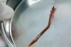 久治不愈！男子剔牙误将牙签吸入肺中感染肺炎，医生提醒：严重可危及生命图片