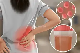 【朝医科普】尿色发红是咋回事儿？图片