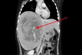 百万分之一！长沙11岁女孩摔倒后疼痛不止，意外发现罕见肿瘤图片