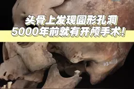 头骨上发现圆形孔洞 5000年前就有开颅手术！图片