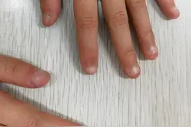 卸完美甲，指甲出现白点毛糙？甲病大汇总，赶紧自查图片