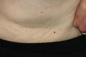 身上突然长的小红点，到底是什么东西啊？会癌变吗？图片