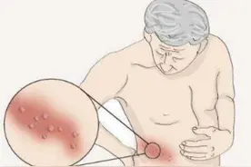 哪类人群容易得带状疱疹？图片