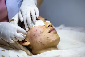 小伙“为美疯狂”，直接用白醋“刷酸”，脸烂了……图片