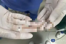 女子总是肚子痛，肠道中抓出10厘米长活虫图片